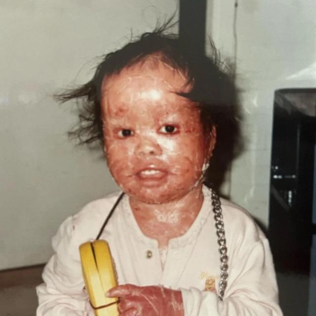 Mui Thomas: The Extraordinary Journey of a Red-Skinned Survivor Who Defied All Odds